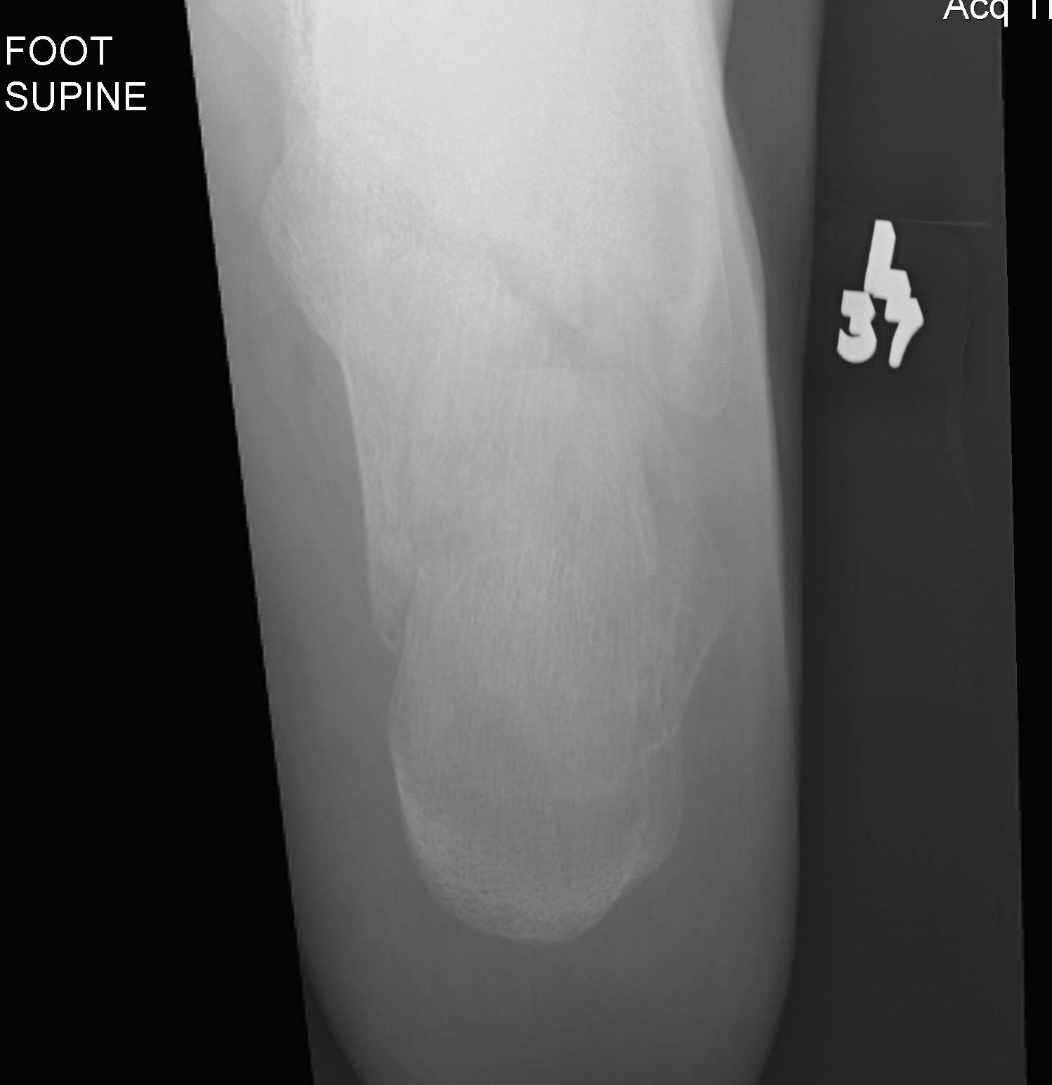 Calcaneal Fracture Harris Axial View